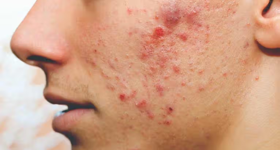 Face Pimple Removal Tips