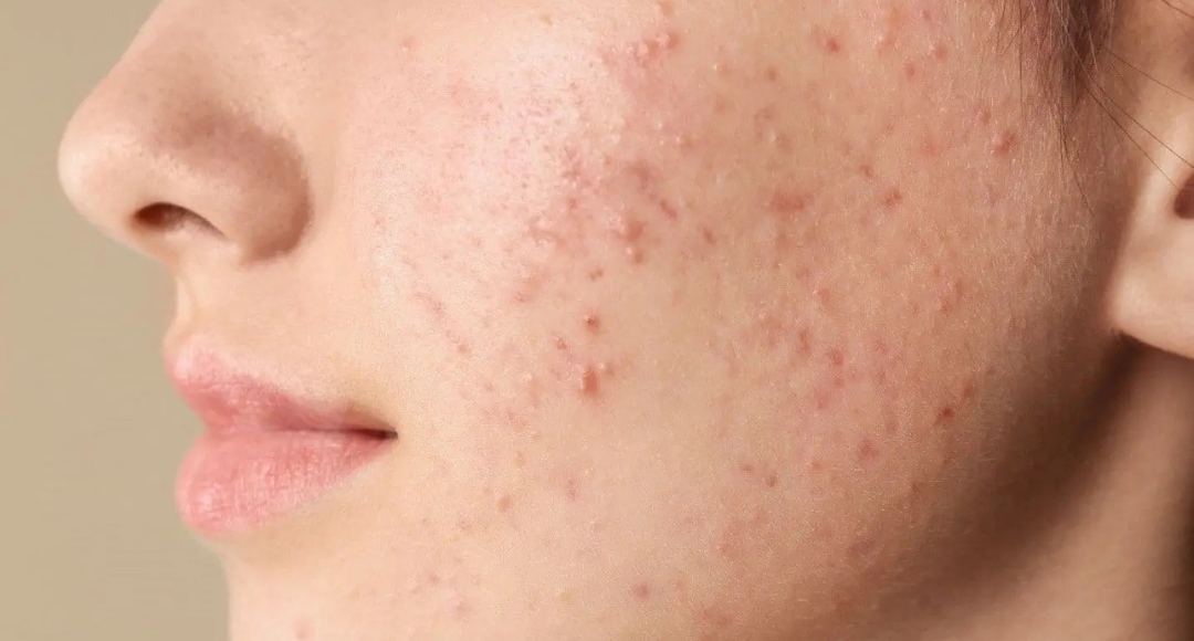 Face Pimple Removal Tips