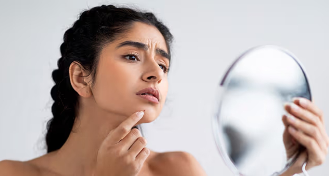 Face Pimple Removal Tips