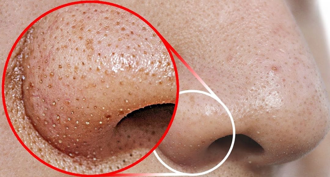 Remove Whiteheads and Blackheads