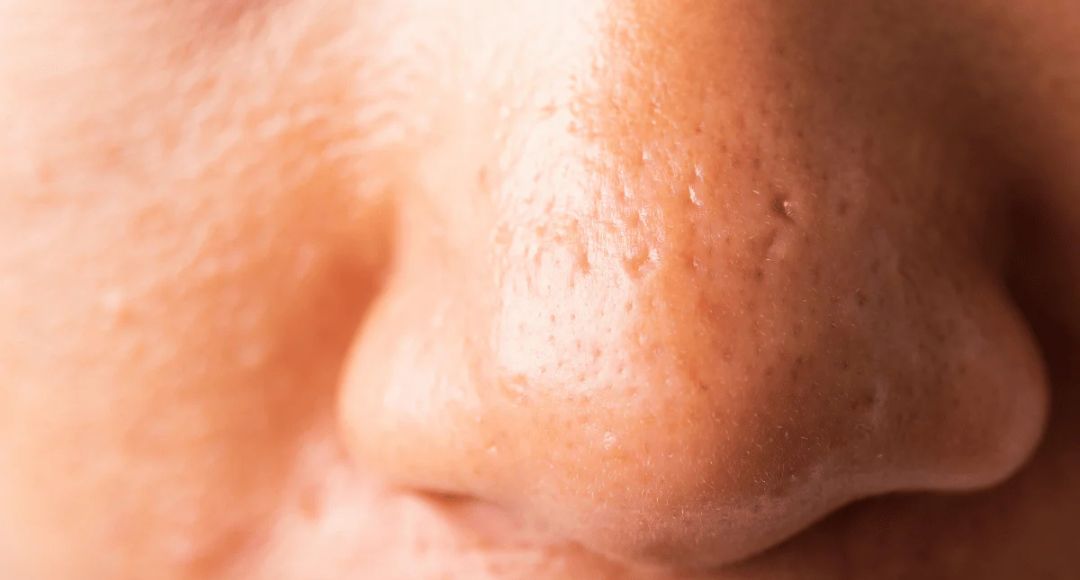 Remove Whiteheads and Blackheads